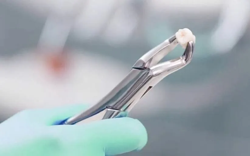 extracción de muelas del juicio